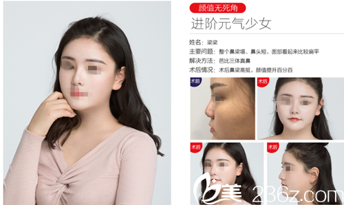 赣州德尔美客韩式生科假体隆鼻，小翘鼻尽显风情，优惠低至4580，院长亲自操刀