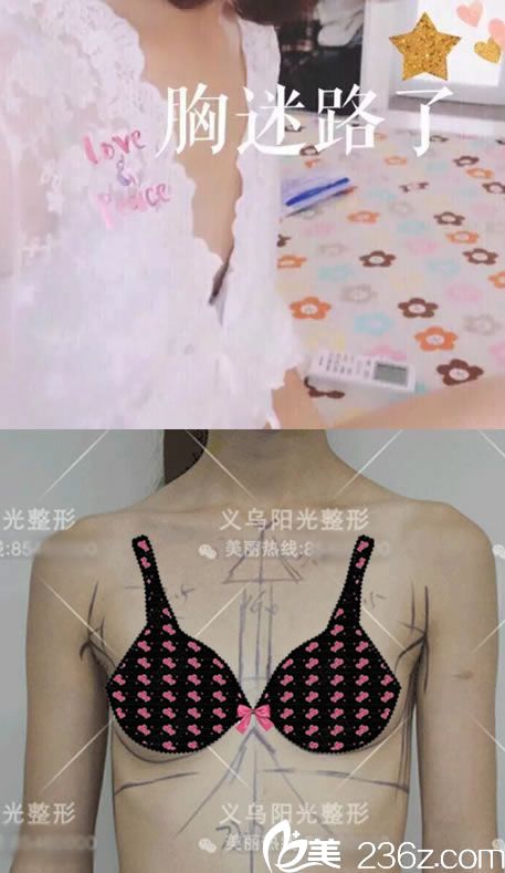 在义乌阳光医院做隆胸前 在义乌阳光医院做隆胸前