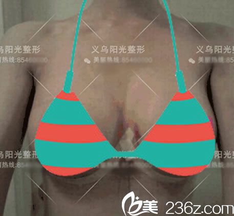 义乌阳光医院刚做完隆胸的图片 义乌阳光医院刚做完隆胸的图片