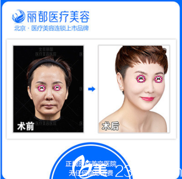 北京米兰柏羽丽都于晓春面部埋线提升案例 北京米兰柏羽丽都于晓春面部埋线提升案例
