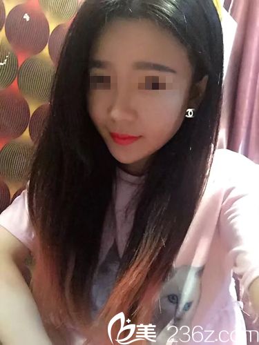 埋线提升术后一周效果