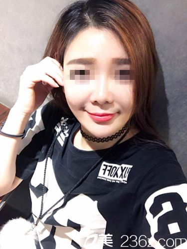 面部埋线提升术后一个多月效果