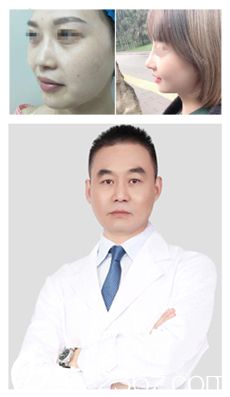 赵峰主任做肋软骨隆鼻术前术后对比