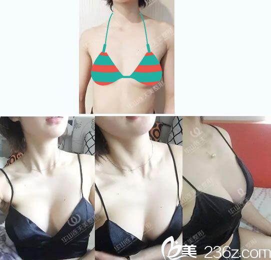 杭州隆胸医生程琳真人案例对比图