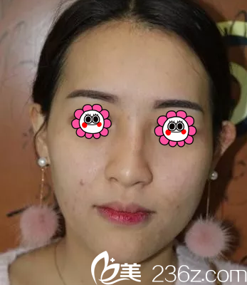 在北京惠合嘉美做自体脂肪面部填充前样子 在北京惠合嘉美做自体脂肪面部填充前样子