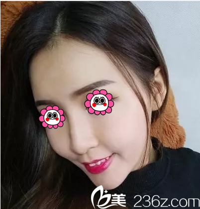 胡俊峰医生给我做自体脂肪面部填充第17天效果 胡俊峰医生给我做自体脂肪面部填充第17天效果