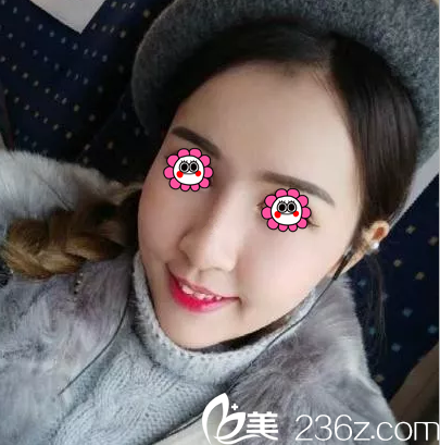 在北京惠合嘉美做自体脂肪面部填充第43天效果 在北京惠合嘉美做自体脂肪面部填充第43天效果