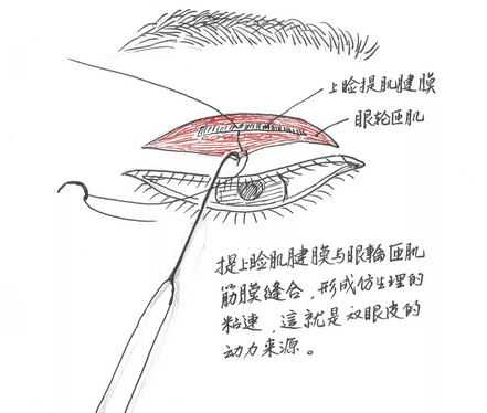 广州博仕仿生理双眼皮手术解剖示意图