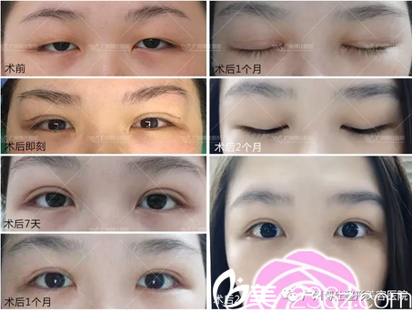 广州博仕李帅敏仿生理双眼皮案例图 广州博仕李帅敏仿生理双眼皮案例图
