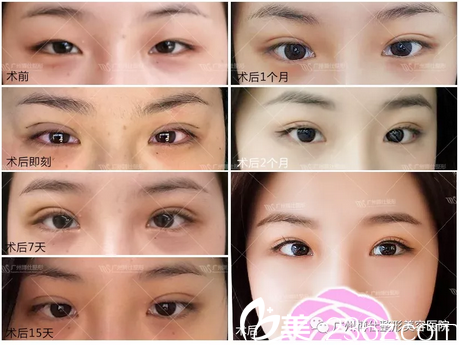 广州博仕仿生理双眼皮手术案例 广州博仕仿生理双眼皮手术案例