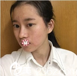 术前我大小眼 术前我大小眼