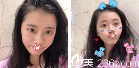 面诊沟通时贵阳甲秀整形的医生王靖说我的大小眼单眼皮割个全切双眼皮就好啦 果然！