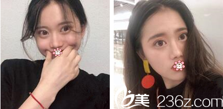 贵阳甲秀整形双眼皮术后2个月 贵阳甲秀整形双眼皮术后2个月
