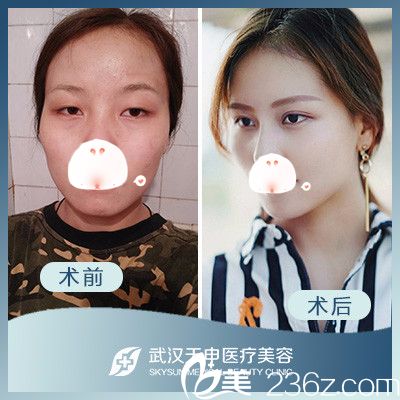 武汉天申整形双眼皮前后对比案例