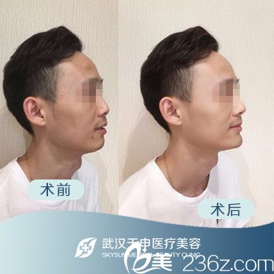 武汉天申整形假体下巴前后对比案例