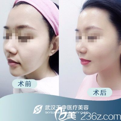武汉天申整形埋线提升前后对比案例