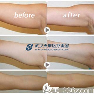 武汉天申整形吸脂前后对比案例