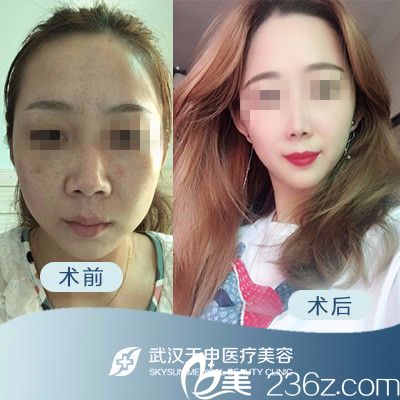 武汉天申整形假体隆鼻前后对比案例