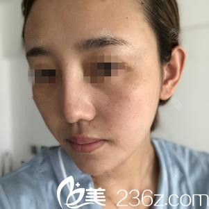 在吉林国健做面部自体脂肪填充前 在吉林国健做面部自体脂肪填充前