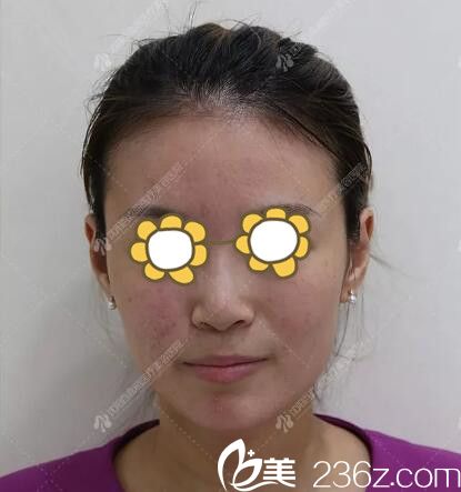 果酸换肤术后即刻效果