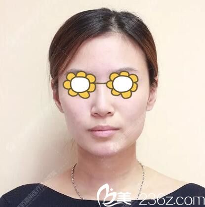 果酸换肤+玻尿酸面部填充+光子嫩肤术后效果