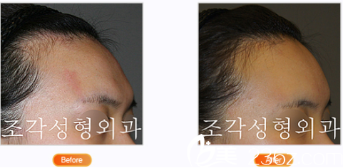 韩国雕刻整形医院向后弯曲的额头整形 韩国雕刻整形医院向后弯曲的额头整形