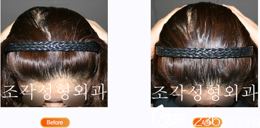 韩国雕刻医院左右不对称后脑勺整形 韩国雕刻医院左右不对称后脑勺整形