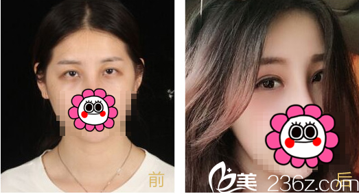 北京京通整形开眼角整形优惠进行中！开眼角价格3800元起