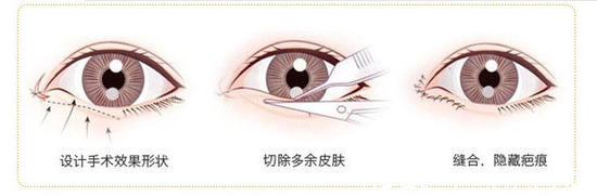 北京京通整形开眼角手术过程示意图