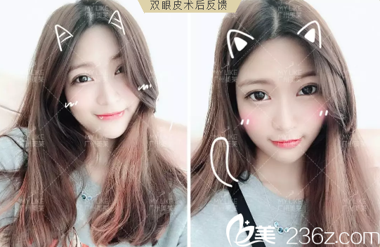 广州美莱曾德渊双眼皮案例