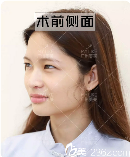 双眼皮术前眼皮下垂