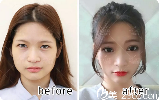 广州美莱曾德渊做双眼皮怎么样