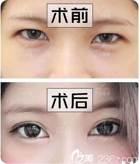 曾德渊双眼皮案例术前术后对比
