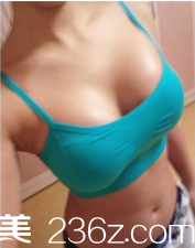 烟台华怡做的自体脂肪隆胸手术，感觉技术还挺不错的