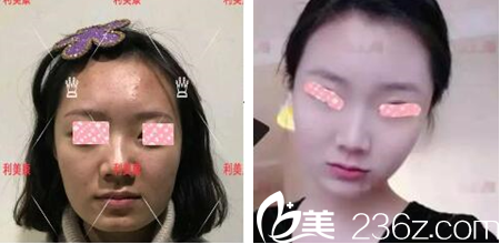 遵义利美康打玻尿酸效果好不好 遵义利美康打玻尿酸效果好不好