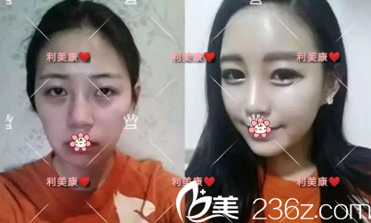 于建涛玻尿酸丰苹果肌案例 于建涛玻尿酸丰苹果肌案例