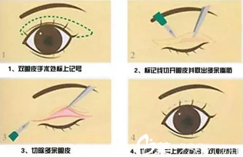 长春做双眼皮修复价格贵吗？长春红星修复双眼皮10800元还你靓丽美眼