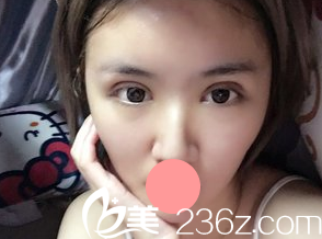 术后30天眼部状态