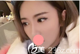 其实我以前是内双啦