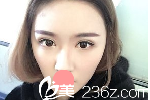 我在德州天宏整形医院做的全切双眼皮手术，感觉恢复的挺不错的