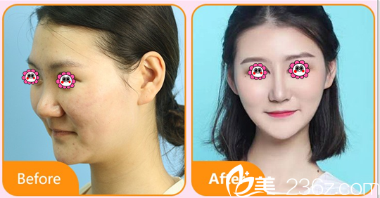 北京艺星整形隆鼻多少钱?BSK宫廷鼻综合隆鼻价格表和案例抢先看