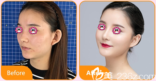 北京艺星慕昕BSK宫廷综合隆鼻案例