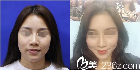 珠海韩妃自体脂肪面部填充效果对比 珠海韩妃自体脂肪面部填充效果对比