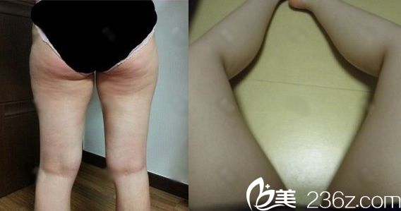 在义乌张小红医疗美容医院吸脂前 在义乌张小红医疗美容医院吸脂前