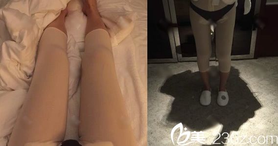 刚做完大腿吸脂的照片 刚做完大腿吸脂的照片