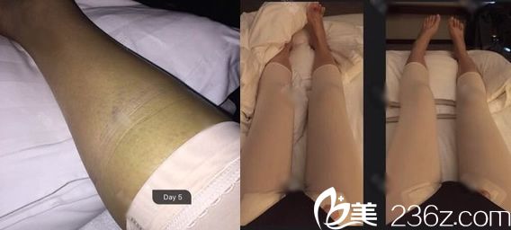 做大腿吸脂手术5天恢复<span style= 做大腿吸脂手术5天恢复<span style=