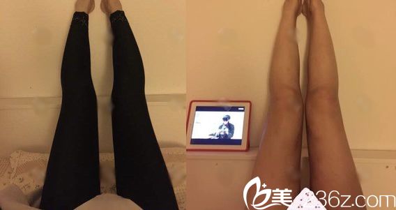 做完大腿吸脂30天恢复<span style= 做完大腿吸脂30天恢复<span style=