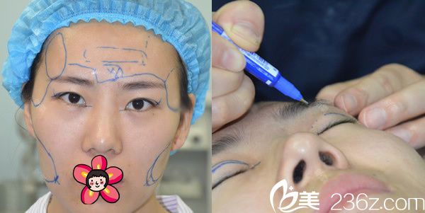 在宁波美莱做双眼皮和脂肪填充前 在宁波美莱做双眼皮和脂肪填充前