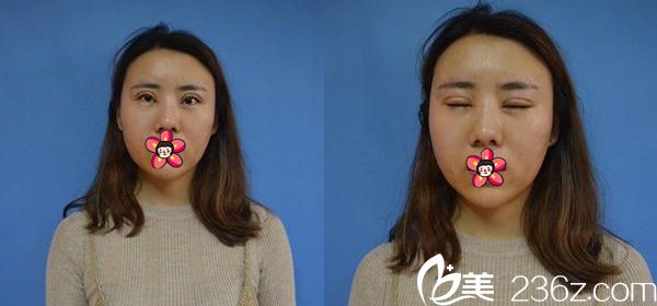 做完双眼皮和自体脂肪填充7天后 做完双眼皮和自体脂肪填充7天后