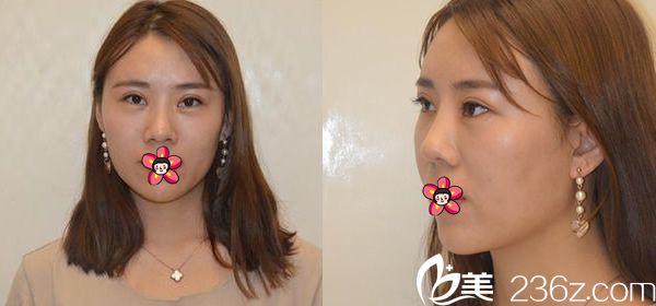 宁波美莱姚远双眼皮脂肪填充案例 宁波美莱姚远双眼皮脂肪填充案例